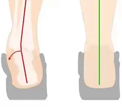 ہیل ایورشن اور ہیل الٹا تشخیص: کلینیکل تشخیص ، عملی ایپلی کیشنز ، اور تجارتی انضمام