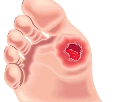 ذیابیطس کے پاؤں کی تشخیص: کلینیکل بصیرت ، رسک مینجمنٹ ، اور تجارتی مواقع