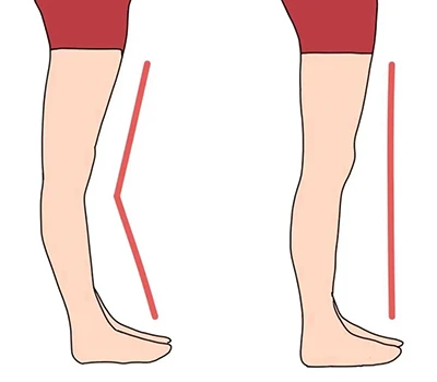 Genu Recurvatum تشخیص اور اصلاح: جدید طریقوں کے لیے ایک طبی اور تجارتی رہنما