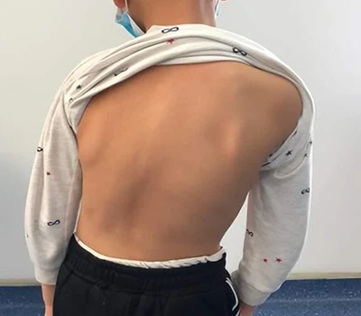 Scoliosis اسکریننگ اور انتظام: کس طرح Xianku 3D باڈی سکینر Chiropractors کی مدد کرتا ہے