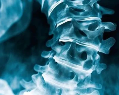 AI Scoliosis اسکریننگ اور اسپائنل الائنمنٹ ٹریکنگ: اسکولوں اور بچوں کے صحت کے مراکز کے لیے ایک ذہ...