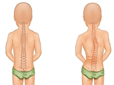 نیا اسکولیوسیس اسکریننگ کا طریقہ: AI اور 3D ڈیجیٹل ریڑھ کی ہڈی