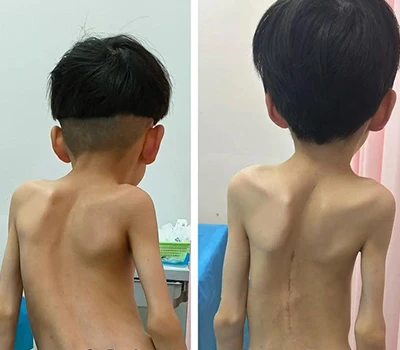 ریڑھ کی ہڈی کی صحت: اسکولیوسیس تشخیص اور مارکیٹ میں تبدیلی میں 3D باڈی اسکیننگ ٹکنالوجی کا کردار